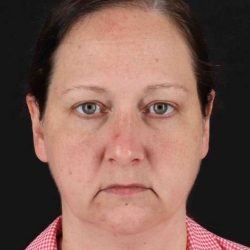 Brow Lift Before & After Patient #4821