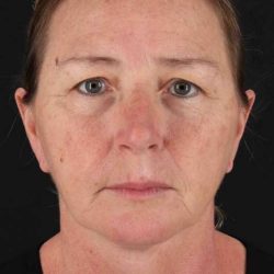 Brow Lift Before & After Patient #4832