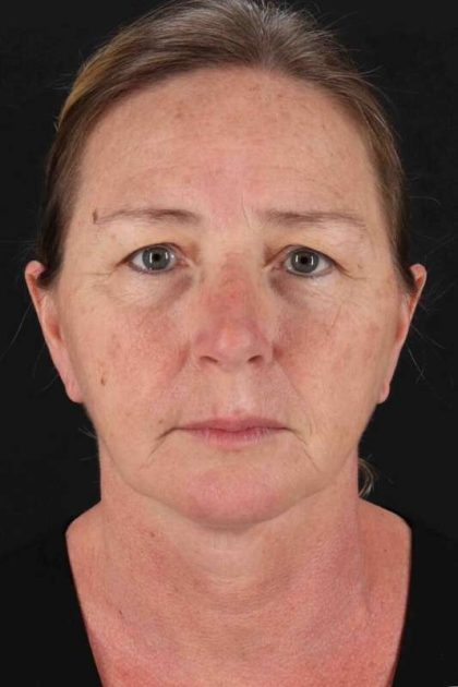 Brow Lift Before & After Patient #4832