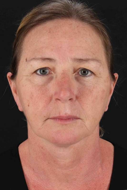 Brow Lift Before & After Patient #4832
