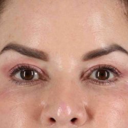 Brow Lift Before & After Patient #4843