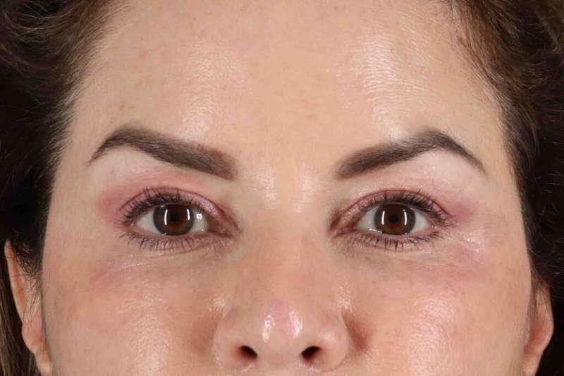 Brow Lift Before & After Patient #4843
