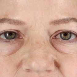 Brow Lift Before & After Patient #4854