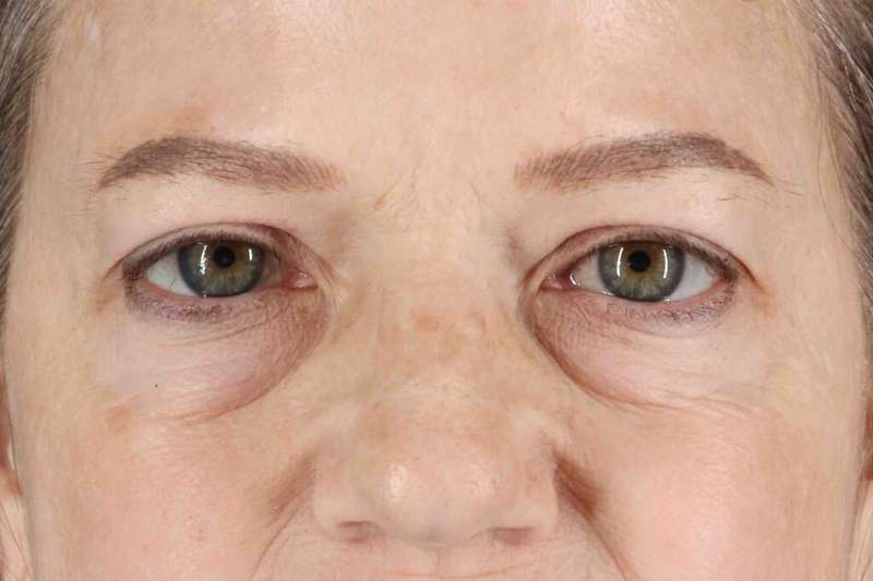 Brow Lift Before & After Patient #4854