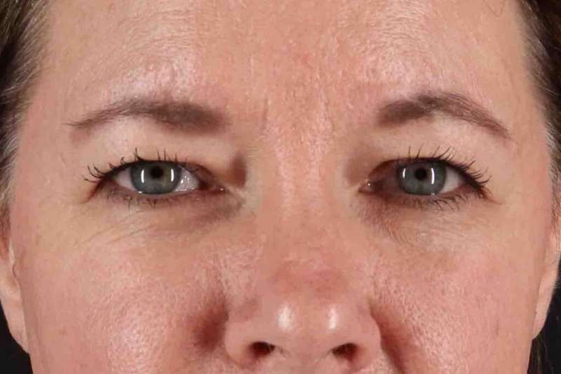 Brow Lift Before & After Patient #4865