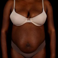 Abdominoplasty (Tummy Tuck) Before & After Patient #1045