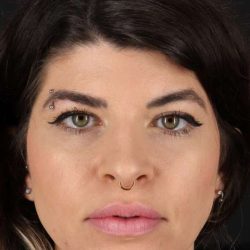 Brow Lift Before & After Patient #4912