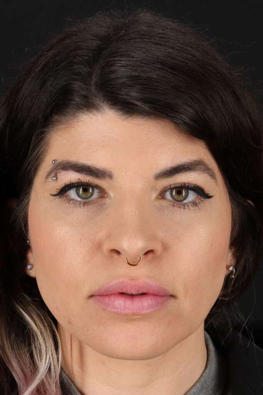 Brow Lift Before & After Patient #4912