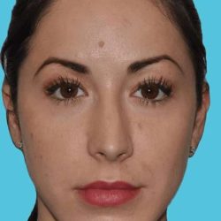 Chin Surgery Before & After Patient #4928