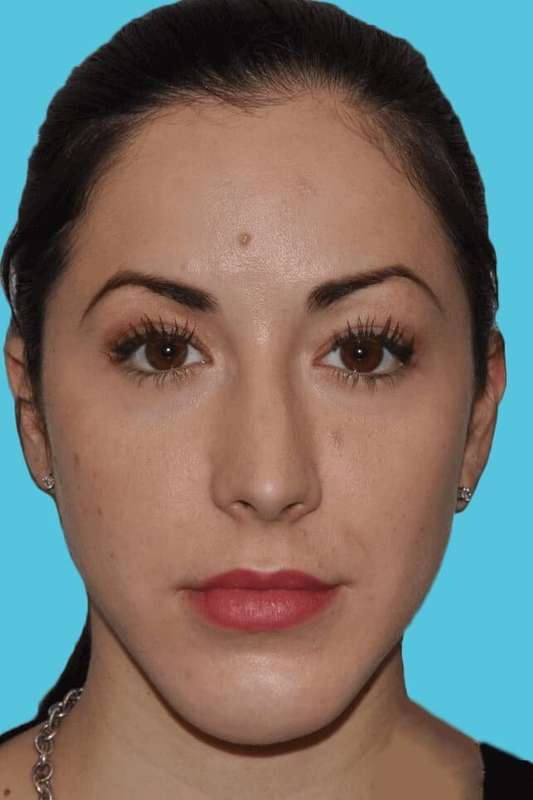 Chin Surgery Before & After Patient #4928