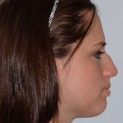Chin Surgery Before & After Patient #4931