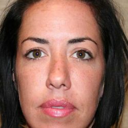 Chin Surgery Before & After Patient #4936