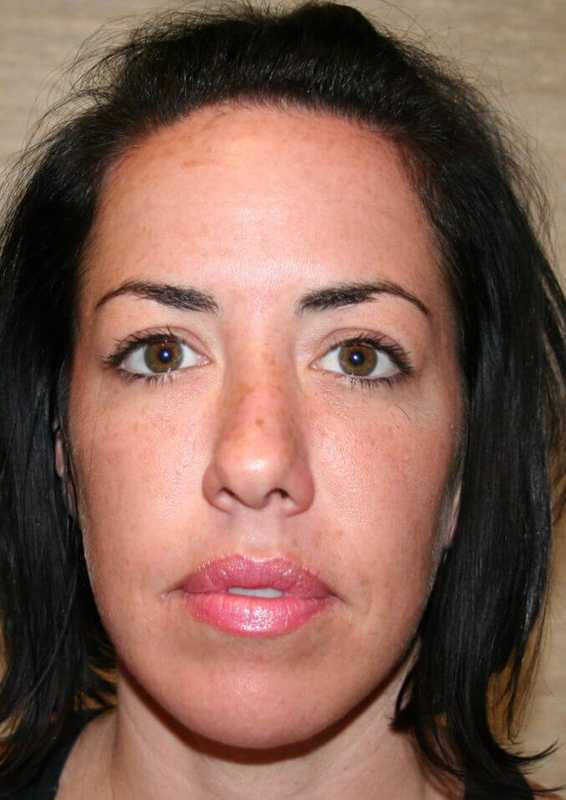 Chin Surgery Before & After Patient #4936
