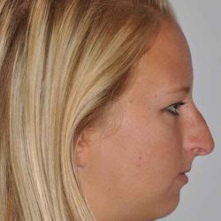 Chin Surgery Before & After Patient #4939
