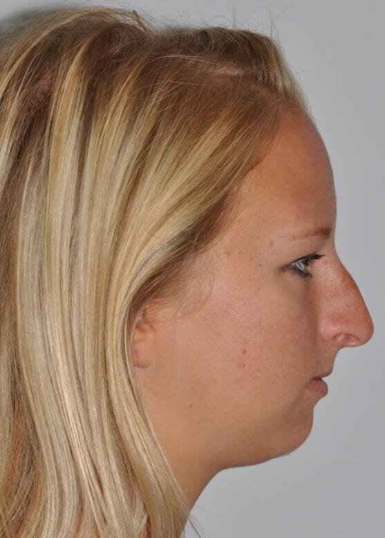Chin Surgery Before & After Patient #4939
