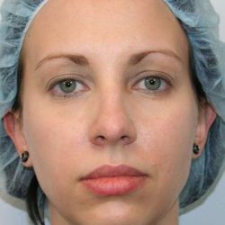 Chin Surgery Before & After Patient #4944
