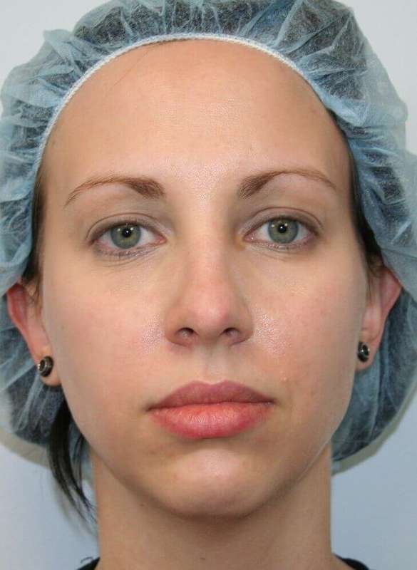 Chin Surgery Before & After Patient #4944