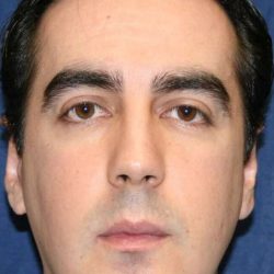 Chin Surgery Before & After Patient #4949