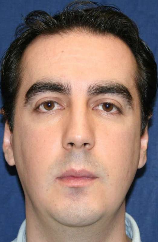 Chin Surgery Before & After Patient #4949