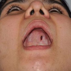 Cleft Lip Palate Before & After Patient #4952