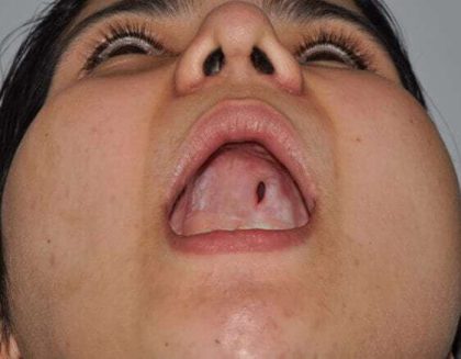 Cleft Lip Palate Before & After Patient #4952