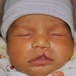 Cleft Lip Palate Before & After Patient #4955