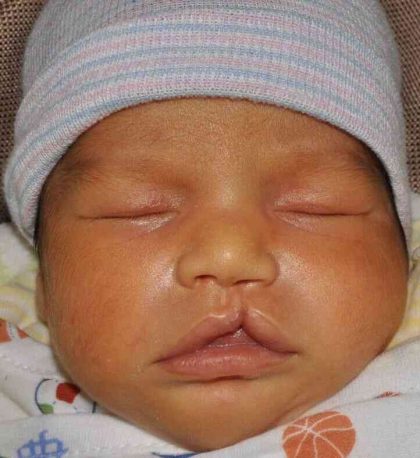 Cleft Lip Palate Before & After Patient #4955