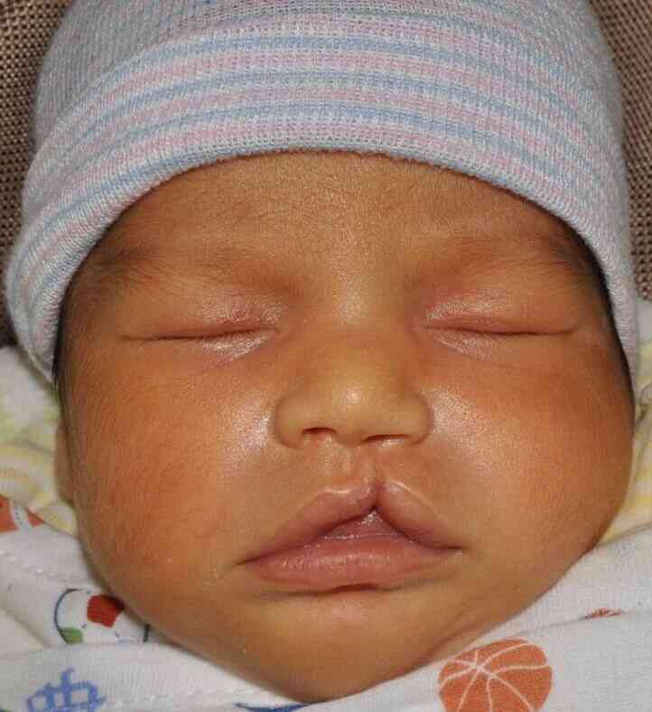 Cleft Lip Palate Before & After Patient #4955