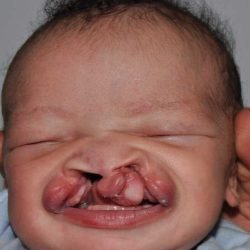 Cleft Lip Palate Before & After Patient #4961