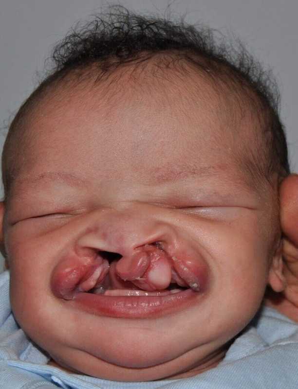 Cleft Lip Palate Before & After Patient #4961