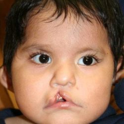 Cleft Lip Palate Before & After Patient #4964