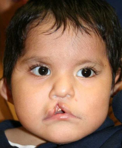 Cleft Lip Palate Before & After Patient #4964