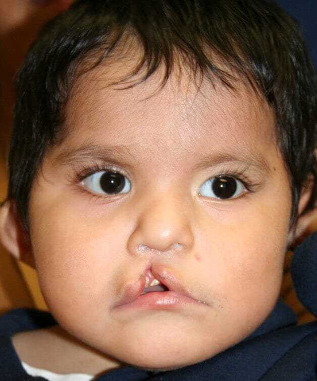 Cleft Lip Palate Before & After Patient #4964
