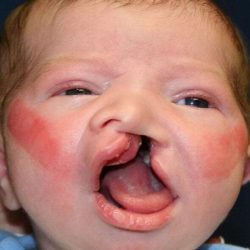 Cleft Lip Palate Before & After Patient #4967