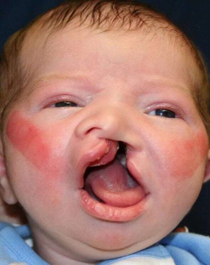 Cleft Lip Palate Before & After Patient #4967