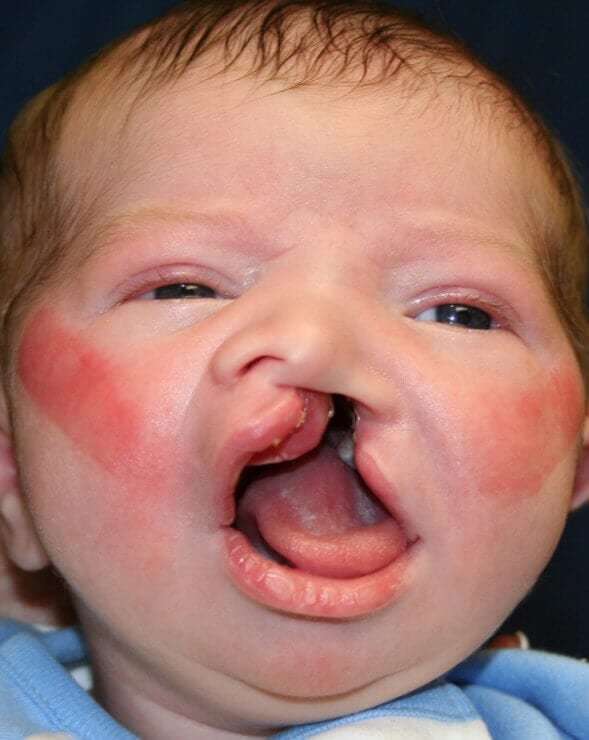 Cleft Lip Palate Before & After Patient #4967