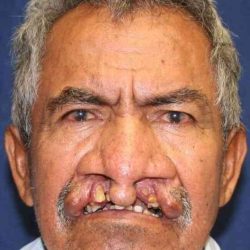 Cleft Lip Palate Before & After Patient #4970