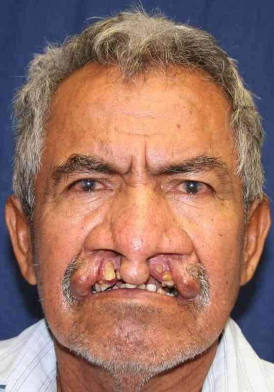 Cleft Lip Palate Before & After Patient #4970