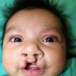 Cleft Lip Palate Before & After Patient #4973