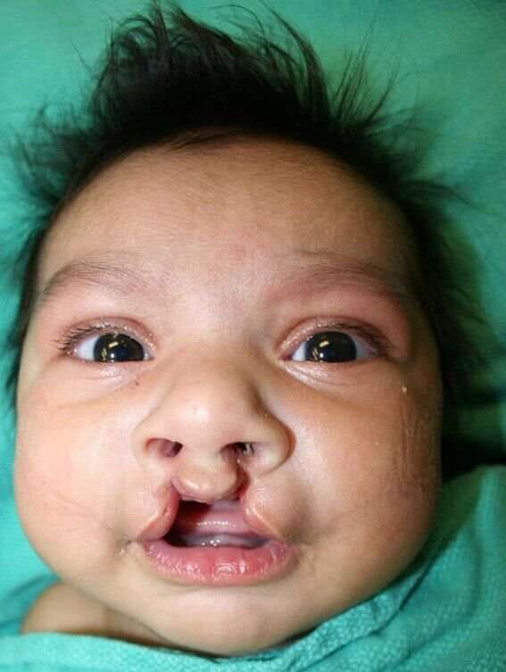 Cleft Lip Palate Before & After Patient #4973