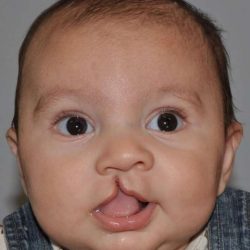 Cleft Lip Palate Before & After Patient #4976