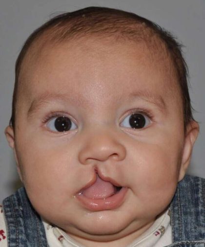 Cleft Lip Palate Before & After Patient #4976