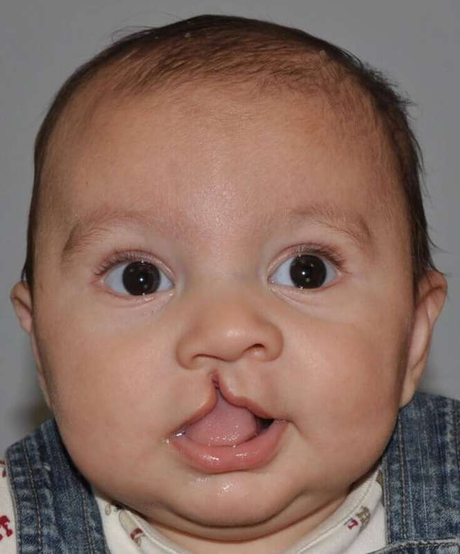 Cleft Lip Palate Before & After Patient #4976