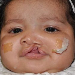 Cleft Lip Palate Before & After Patient #4979
