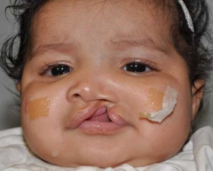 Cleft Lip Palate Before & After Patient #4979