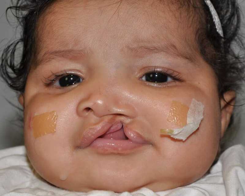Cleft Lip Palate Before & After Patient #4979
