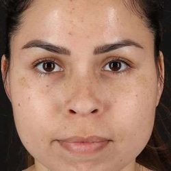 Cosmetic Injectables Before & After Patient #4990