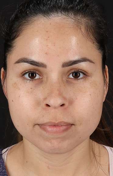 Cosmetic Injectables Before & After Patient #4990