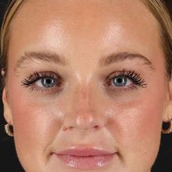 Cosmetic Injectables Before & After Patient #5004