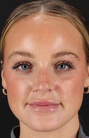 Cosmetic Injectables Before & After Patient #5004